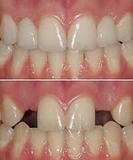 Missing lateral teeth before and after replacments