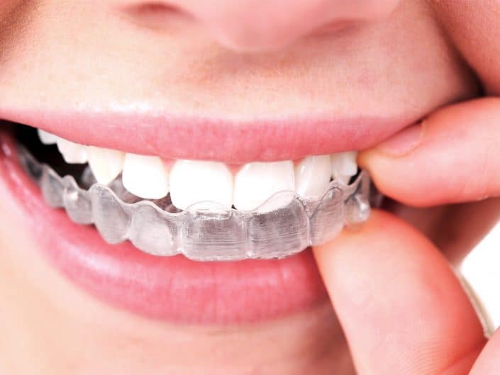 5 Facts About Rubber Bands for Braces That You Must Know