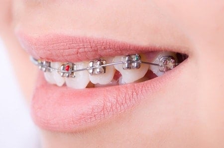 Metal Braces in Medina OH