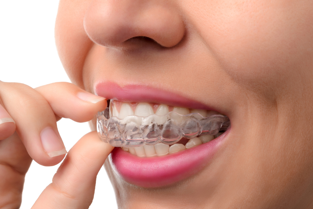 6 Easy Steps to Keep Your Invisalign Clear Aligners Clean and Fresh